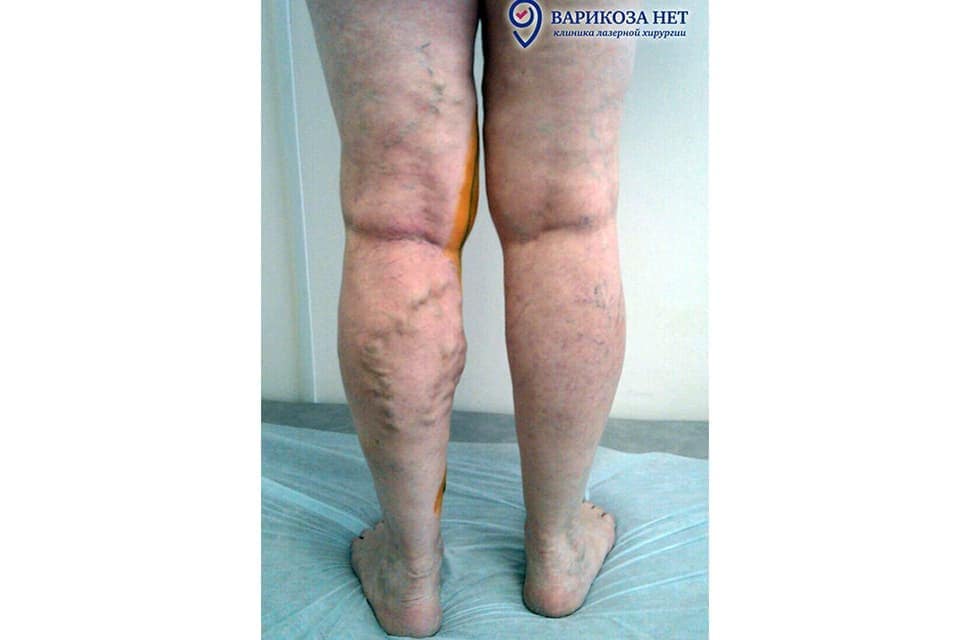 Tratamentul cuponului varicoza - Cumpărați șosete anti-varicoase pentru bărbați în Chelyabinsk