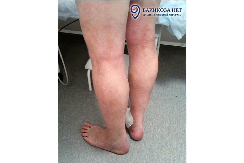 tratamentul etapei iniiale ale picioarelor varicoase)