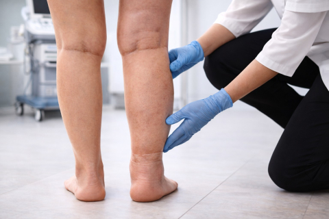 Отек только одной ноги - когда это опасно