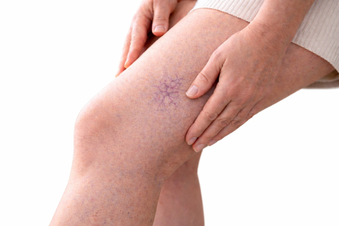 Сосудистая сетка - косметический дефект или начало болезни