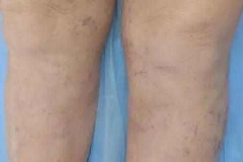 Почему появляются капилляры на ногах