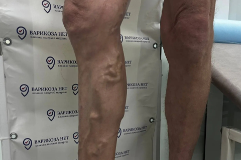 Лечение выраженного варикоза - результат после комплексного лечения