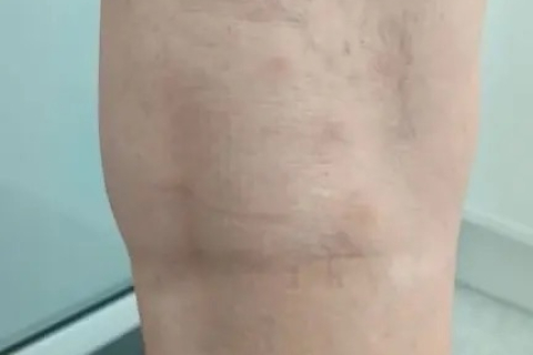 Удаление сосудистых сеток на ногах - результат после склеротерапии